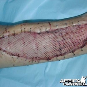 Puff Adder Bite