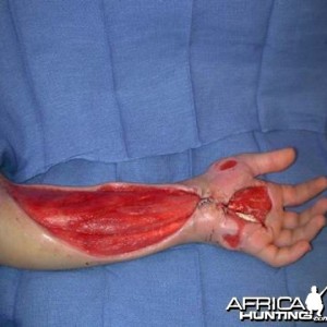 Puff Adder Bite