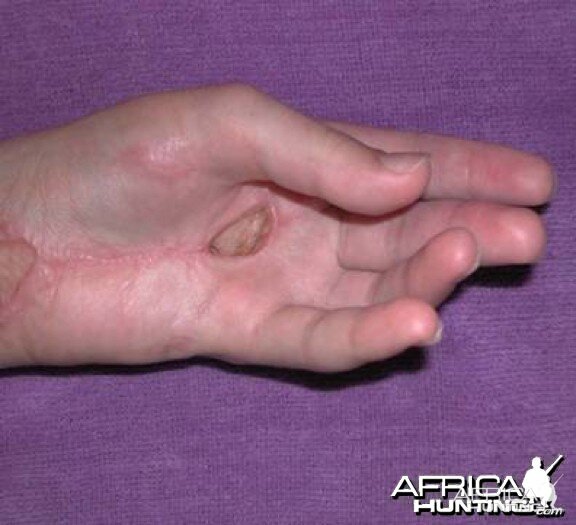 Puff Adder Bite