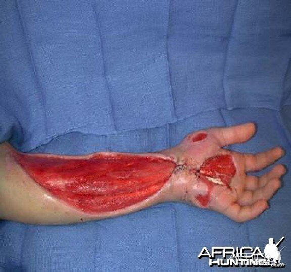 Puff Adder Bite